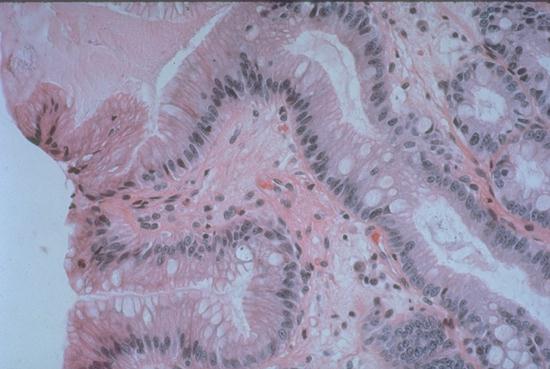 Stomach Pathology