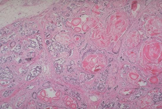 Fibrocystic disease of the pancreas (cystic fibrosis). The genetic defect in 