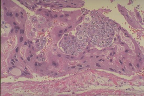 Male Urinary | UW Medicine Pathology Male Urinary | UW Medicine Pathology