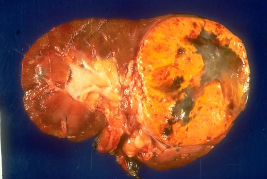 There is a large renal cell carcinoma in the upper pole with a typical 