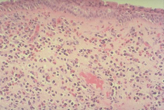 allergic nasal polyp