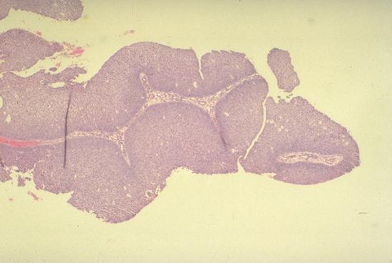 pathology outlines squamous papilloma