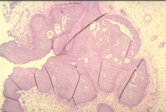 Nasal Inverted Papilloma