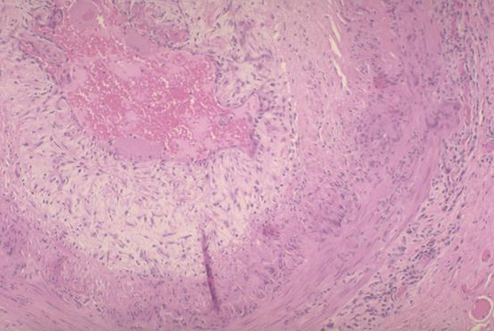 V 1 Giant Cell (Temporal) Arteritis