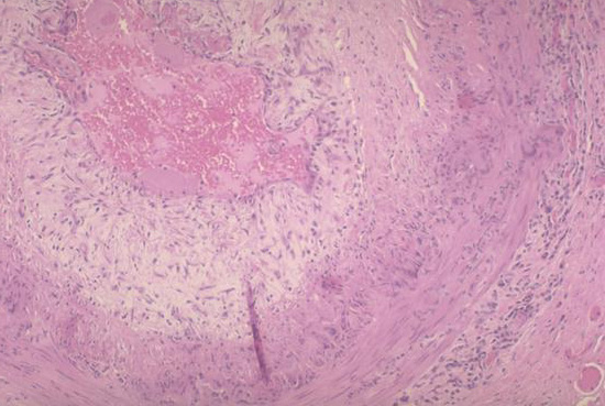 V 1 Giant Cell (Temporal) Arteritis V 1 Giant Cell (Temporal) Arteritis