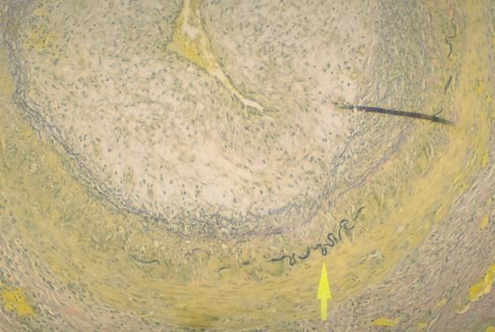 V 2 Giant Cell (Temporal) Arteritis-Elastic Tissue Stain
