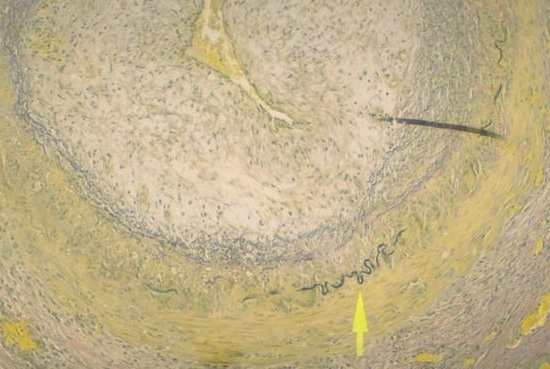 Yellow Elastic Tissue