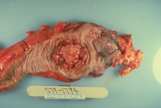 Adenocarcinoma of colon. This en face view of an opened colon shows a 