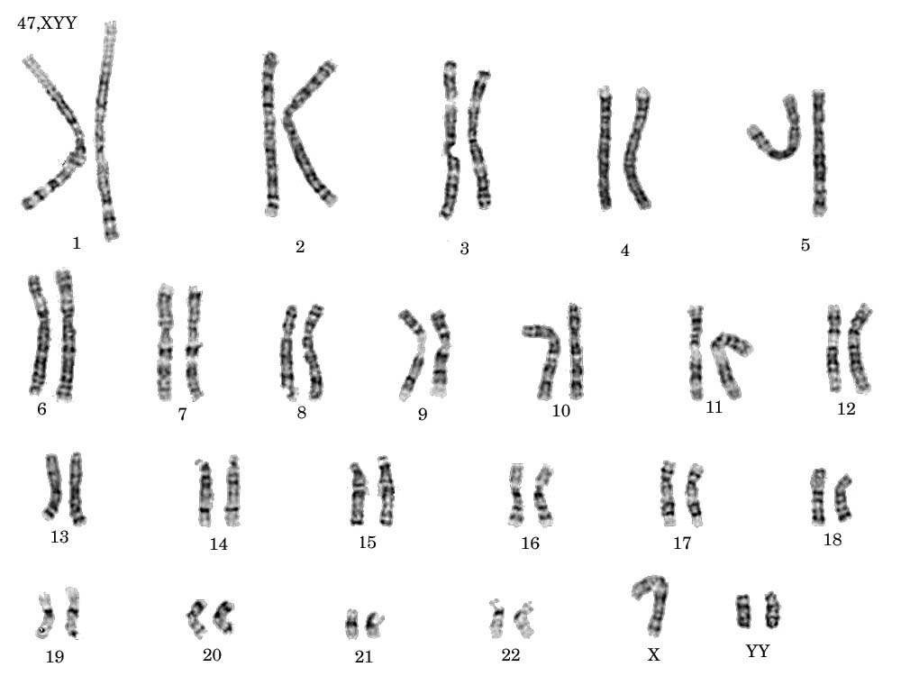 Triple-X syndrome images