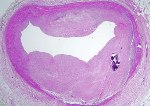atherosclerotic coronary artery
