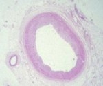 normal coronary artery