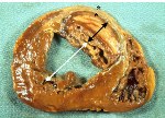 left ventricular remodeling